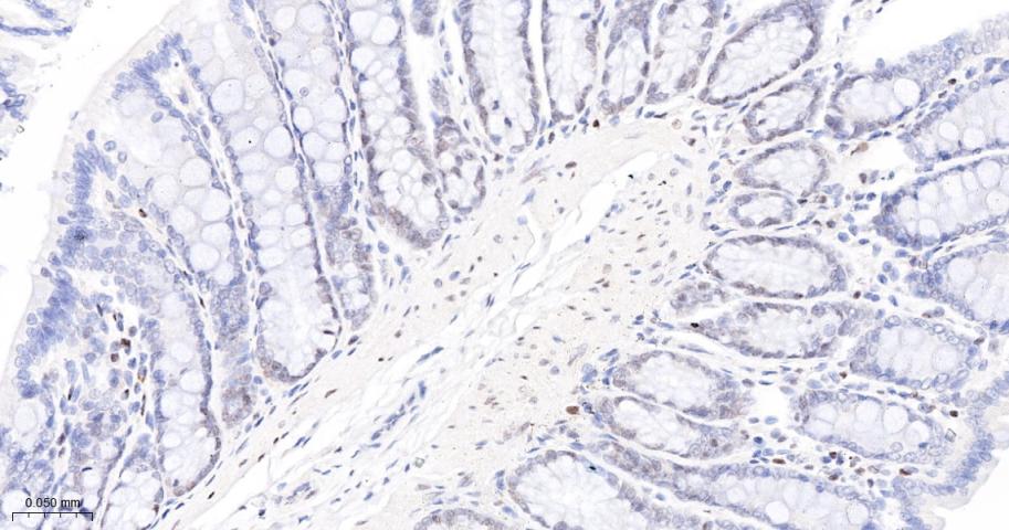 多腺苷二磷酸多聚酶/多聚ADP-核糖聚合酶1重组兔单抗-bsm-52408R